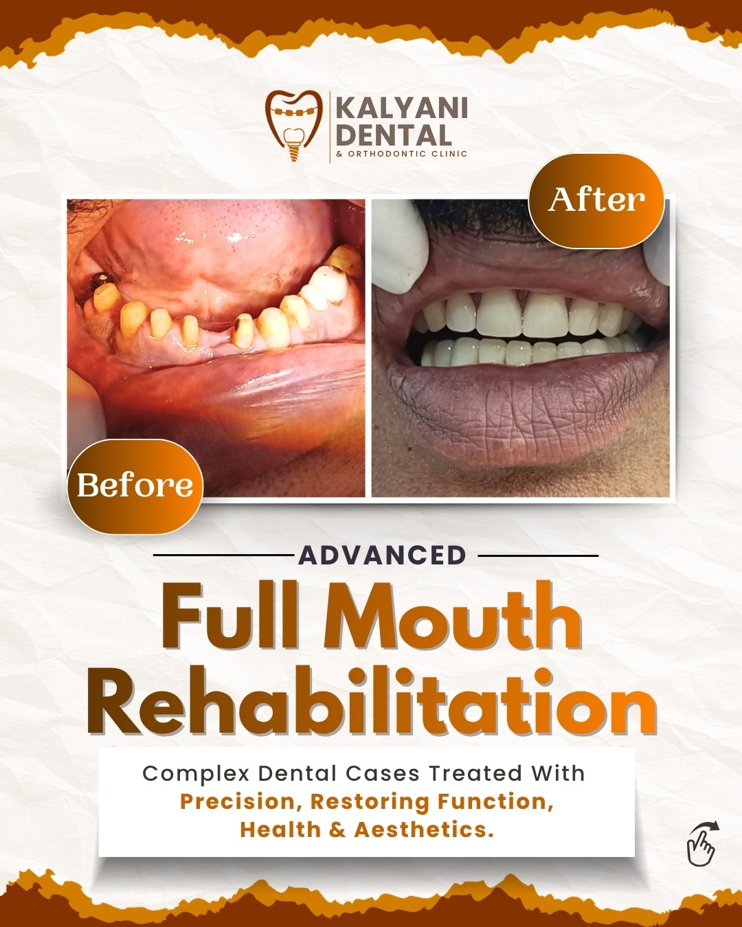Advanced Full Mouth Rehabilitation