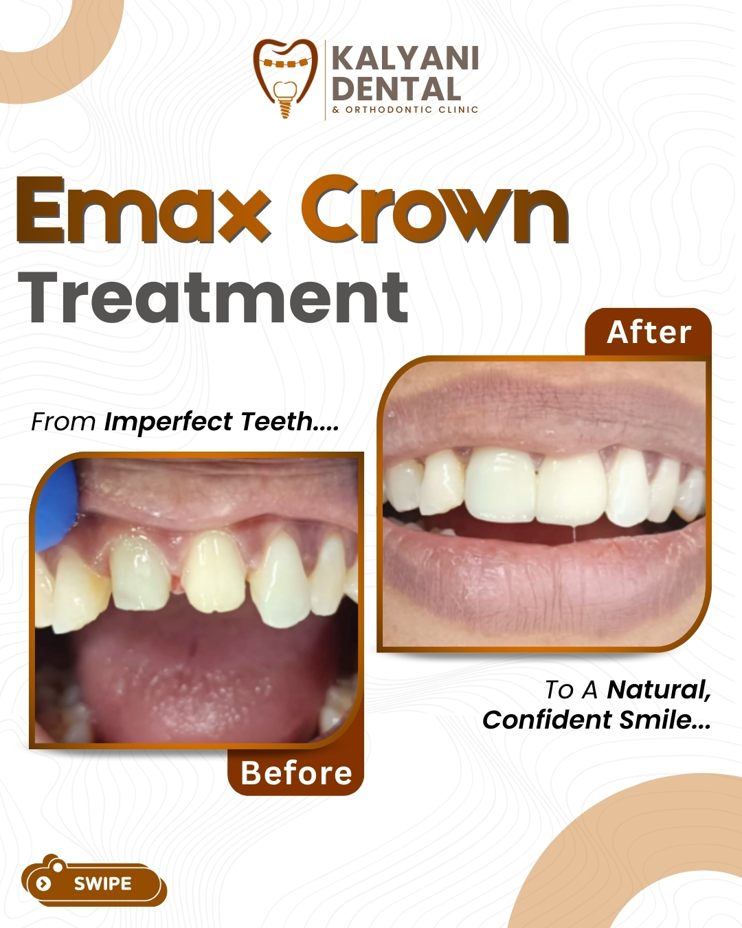 Natural Smile with Emax Crowns