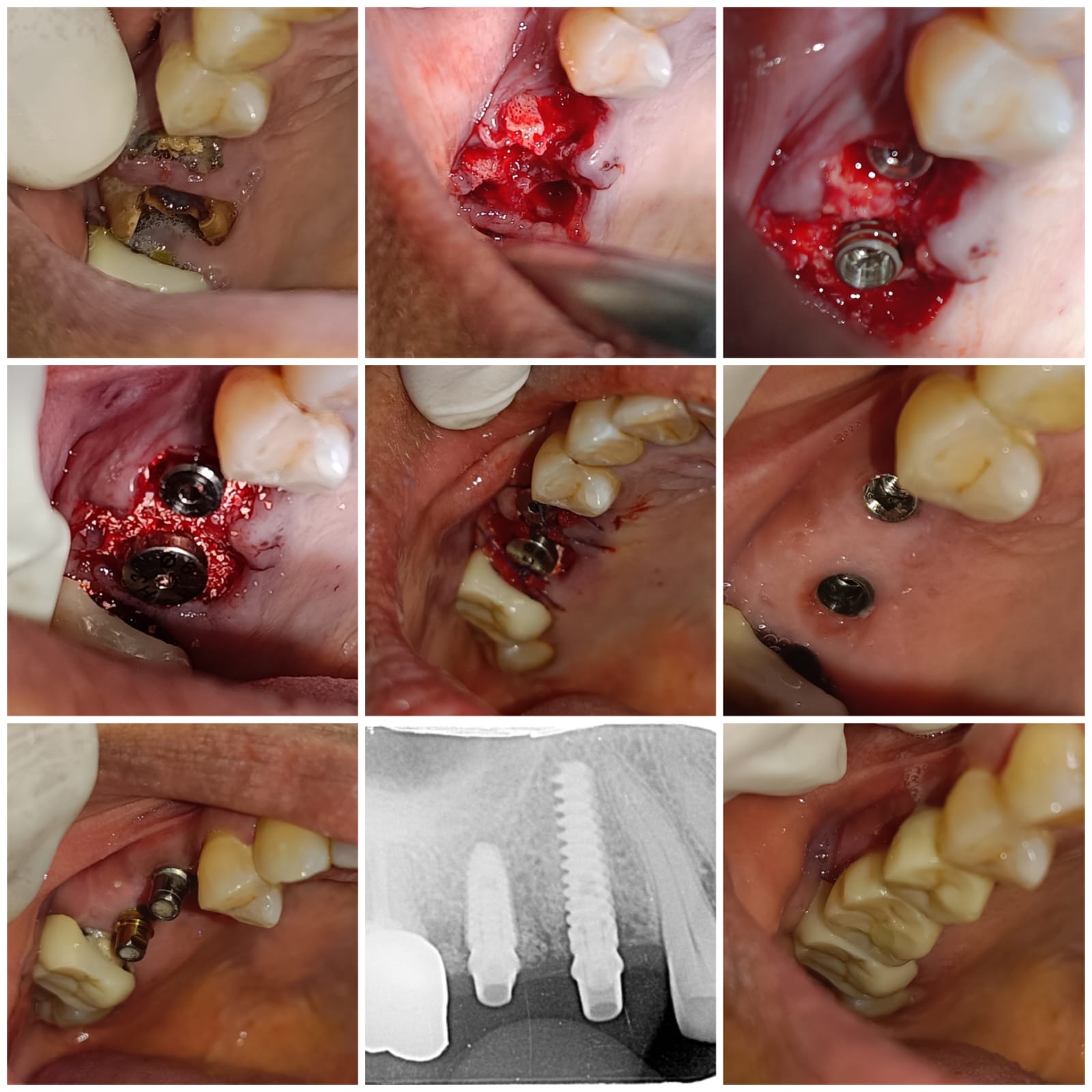 Immediate implants and crowns