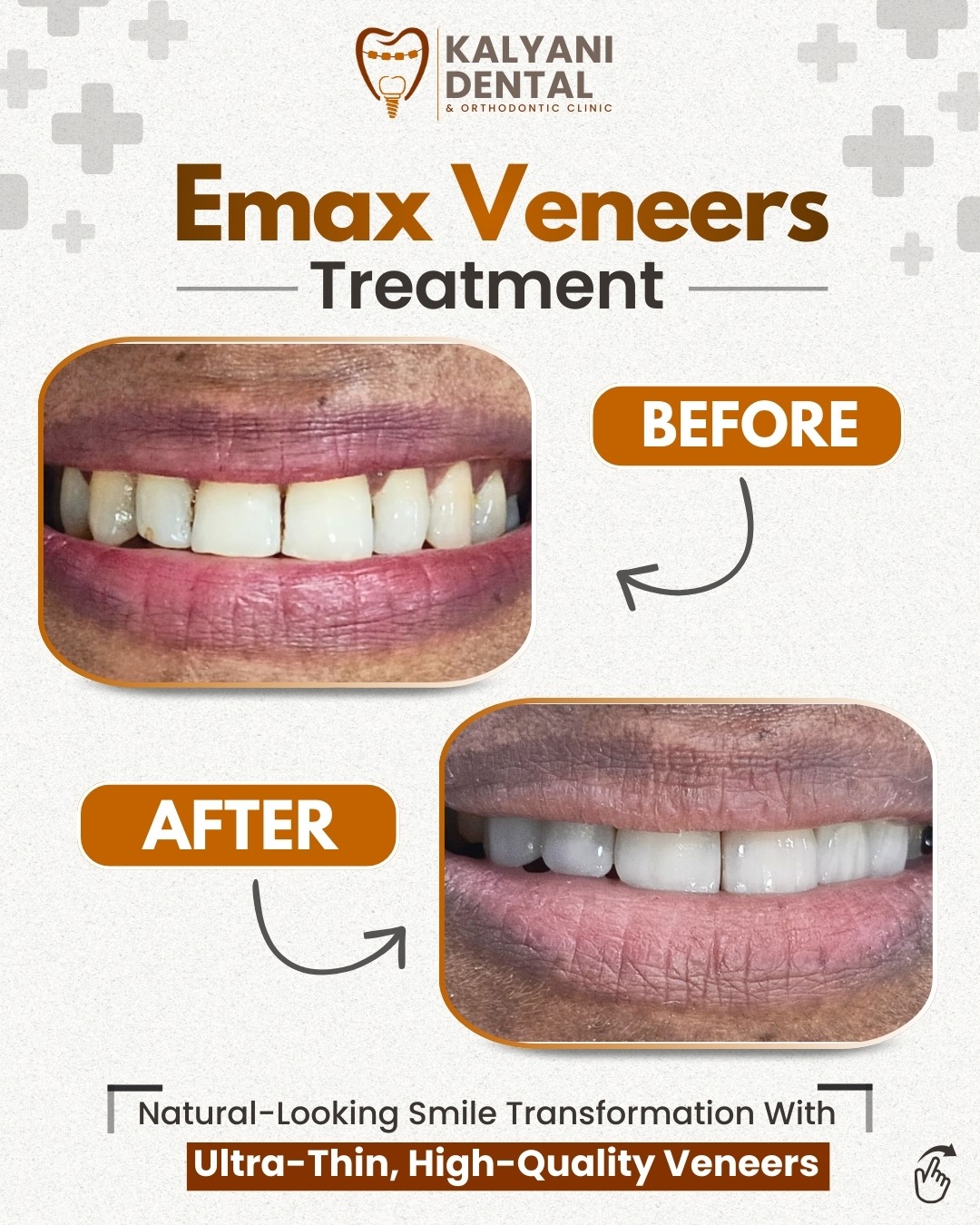 Natural-Looking Emax Veneers