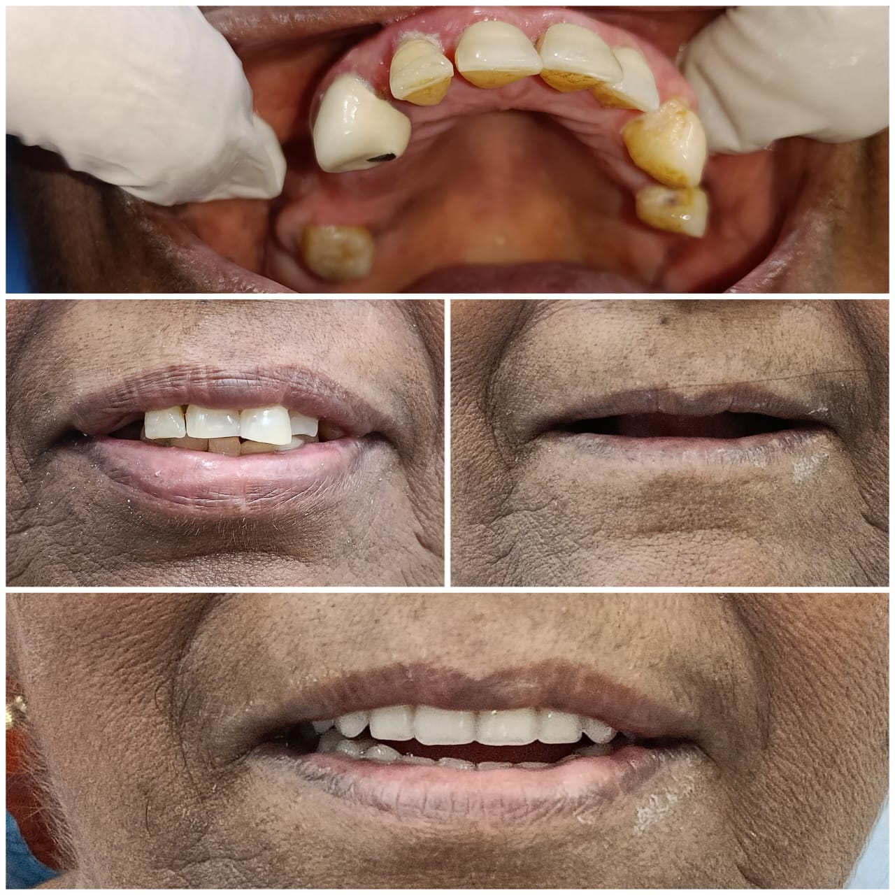 Full mouth rehabilitation
