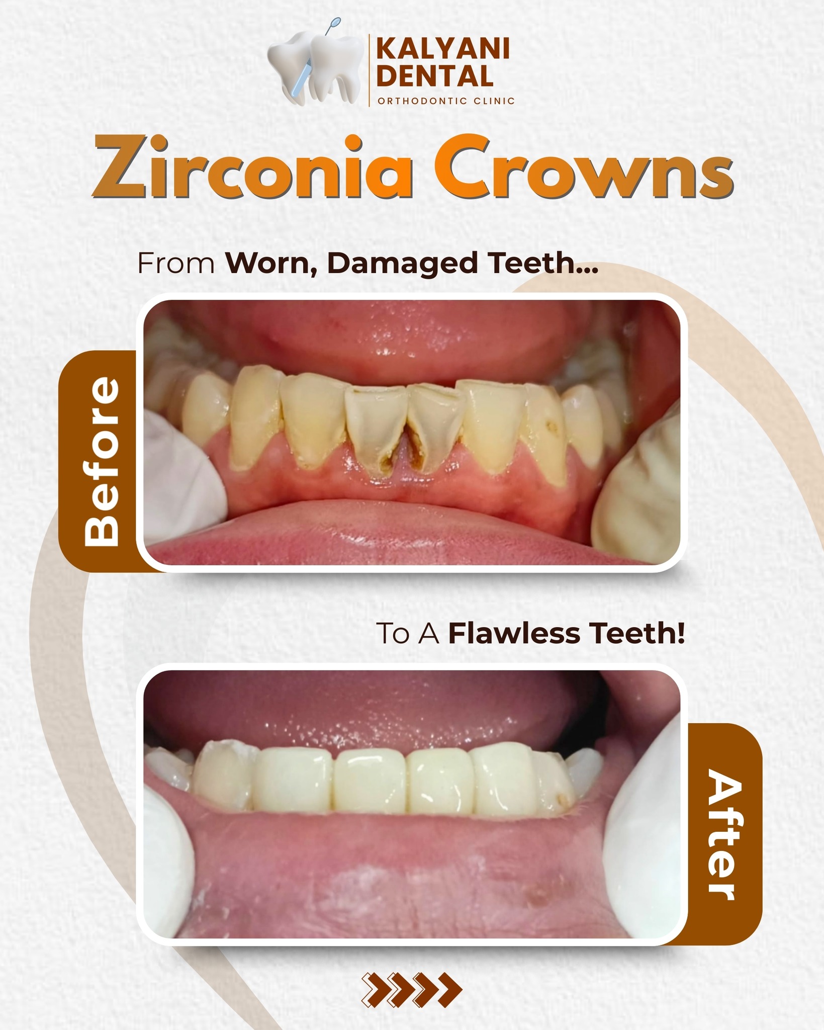 Strong & Aesthetic Zirconia Crowns