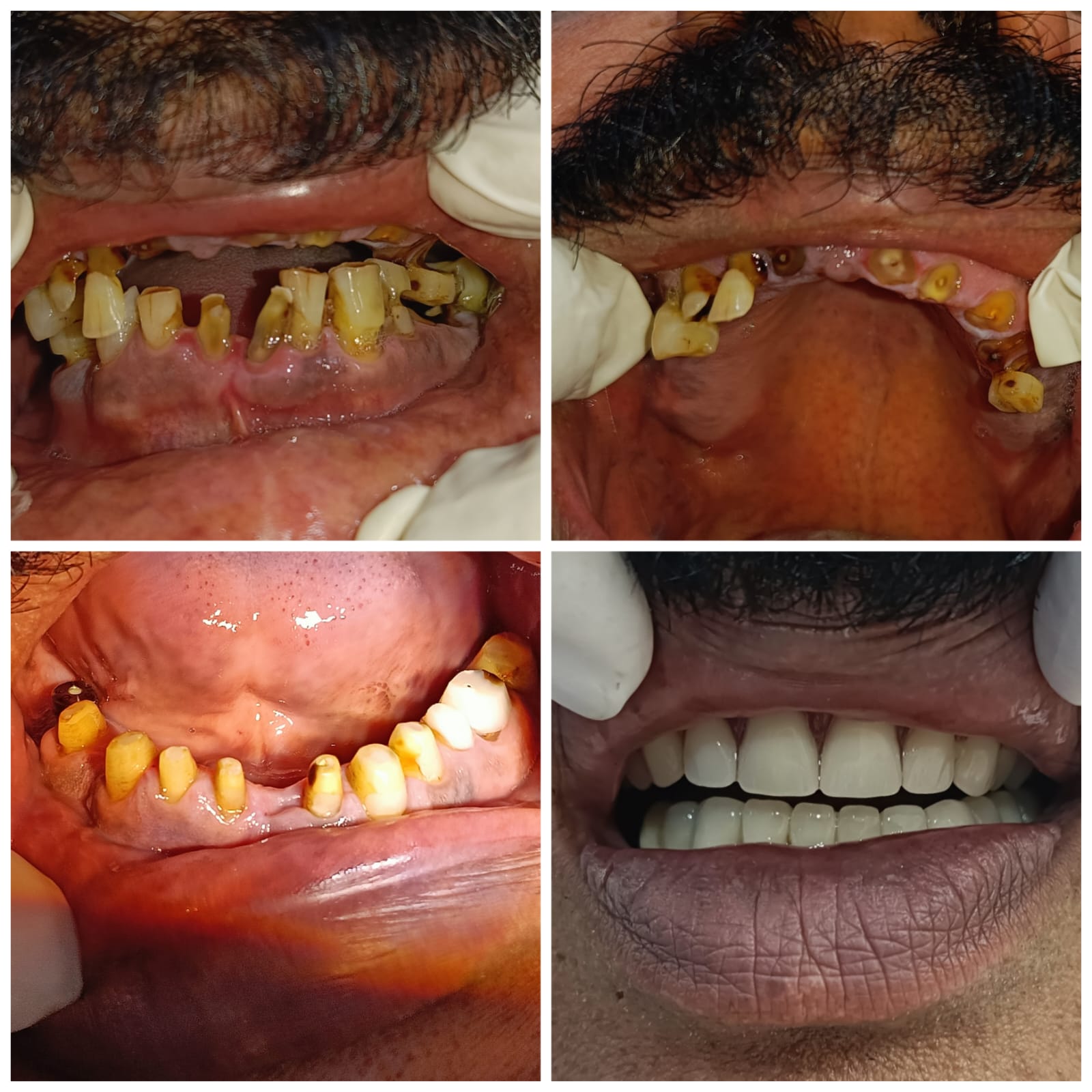 Full mouth rehabilitation